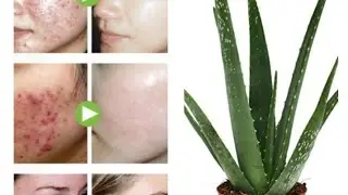 Amazing Benefits of Aloevera jel ! acny free skin & stratae long hairs