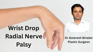 Wrist Drop Corrective Surgery. Tendon Transfer . Dr Amaresh Biradar Plastic Surgeon. 