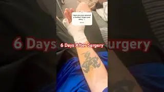 Injury Update - day 6 recovery #laceration #tendon #recoveryjourney #surgery #bruising  #ouch #viral