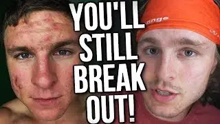 YOU WILL BREAK OUT IF YOU DON'T DO THIS (PROOF)