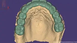 Designing Post and Core for Dental Lab
