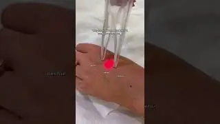 Почему лазерная эпиляция не даёт результата некоторым 😬