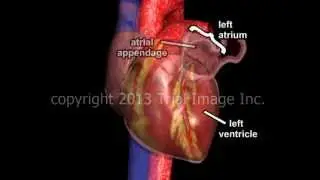 Atrial Fibrillation and Stroke video - Animation and Narration by Cal Shipley, M.D.