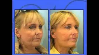 Weekend Facelift Webinar by Dr. Edwin Williams
