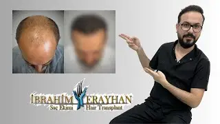 Saçekimine Karşı Olan Kişinin Saç Ekimi ile Harika Değişimi👍 | Wonderful Change with Hair Transplant