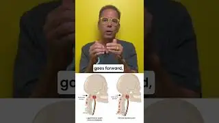 Long haul covid and vagus nerve degeneration #longcovid #vagus #cervicalinstability