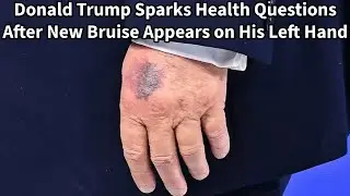 Trump's Mysterious Hand Bruise Sparks Health Concerns