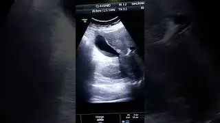 sludge in GB #ultrasound #sludgecore #gb #medicalimaging #viralvideo #performence