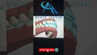 Aligner Design in 3Shape Ortho System 🦷✨  Full Digital Workflow #ClearAligner #DigitalDentistry