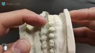 How to QC an upper night guard with lateral disclusion.