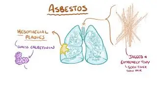 Mesothelioma   causes, symptoms, diagnosis, treatment, pathology