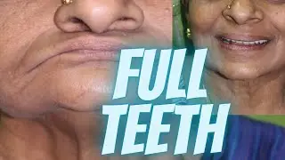 Full mouth dental implants cost in Chennai | Teeth Implant Cost in India | Dr.MKP