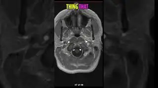 Brain Shrinkage & Black Holes  MS MRI Scan Explained