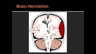 Intracranial Hemorrhage - Epidural Hematoma