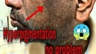 Causes of black spot on face/ pigmentation on face/ kalo dager karon abong chikischa