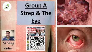 Group A Strep & How it Effects the Eye: Should I Be Worried? I Dr Shaz Rehan, 2023