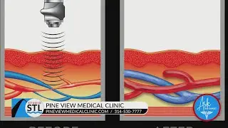 Pine View Medical Clinic offers non-invasive solution for E.D.