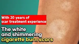 Pinholxell method! You can also get rid of cigarette burn scars.