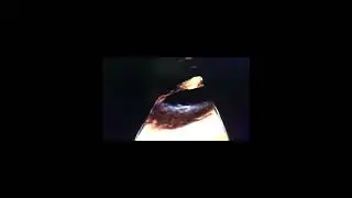 Aortic Dissection: Is It Accompanied by a Clot?