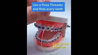Maintenance of Oral Hygiene During Braces Treatment. #bestdentalclinicinnoida #bestdentistinnoida