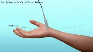 TCTR Thread Carpal Tunnel Release - Animation