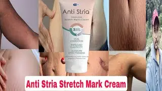 Anti Stria Stretch Mark Cream Review