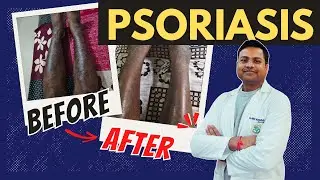Psoriasis Treatment In Hindi | Psoriasis treatment in Hindi |
