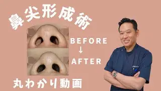 【鼻尖形成術だけ症例】@山本クリニック　#鼻尖形成だけ　#鼻整形　#鼻整形ダウンタイム　#鼻先整形