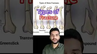 Types of fracture