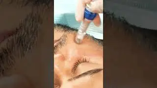 Unlock Timeless Beauty: Experience the PRP Facial Rejuvenation Transformation ✨