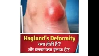 What is Haglund deformity and what is its treatment?