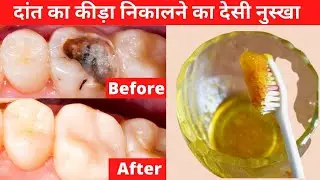 एक बार में दांत का कीड़ा और दर्द बाहर निकालने का अचूक उपाय | Teeth Pain Relief Home Remedy In Hindi
