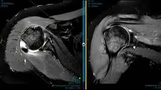 Shoulder pain, weakness, and instability
