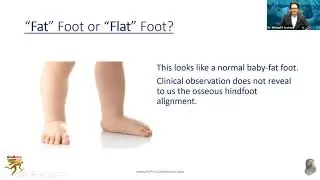 Pediatric Flatfeet – a Disaster in the Making