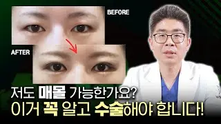 쌍꺼풀 수술 매몰법, 이거 꼭 알고 받아야합니다!