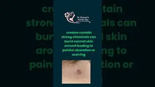 Skin tag removal #dermatologistadvice