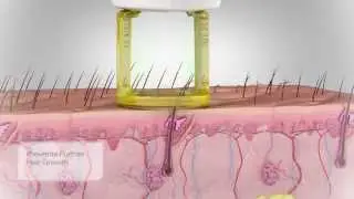 Gentle Hair Removal Video