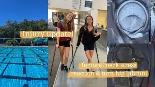 injury update! runner recovering from femoral neck stress reaction + hip labral tear