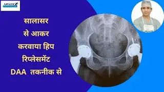 DAA me hip replacement karwane pure india se aa rahe hain log #DAA #hipreplacement #THR #besthip