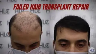 Failed Hair Transplant Repair, Hair transplant before and after