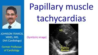 Papillary muscle tachycardias