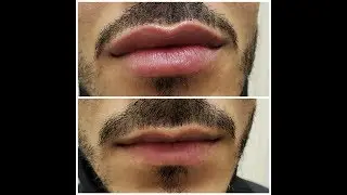 Aumento de labios con &Aacute;CIDO HIALUR&Oacute;NICO - EN HOMBRES