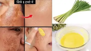 Dark Spots & Pigmentation Removal Lemon Grass Face Pack to get Youthful, Spotless and Glowing Skin