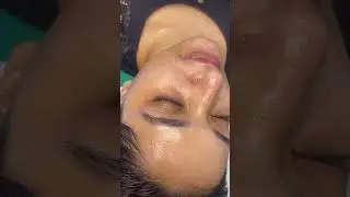 HydraFacial MD Glow | Medical Grade Facial | Oily Acne Prone Skin | Korean Glass Skin | Healthy Skin