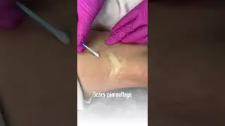 SCAR CAMOUFLAGE DUBAI #scarremoval #skincamouflageservices #stretchmarkscamouflage #scarcamouflage