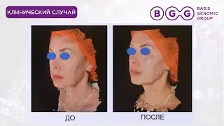 Почему Ulthera НЕ РАБОТАЛА? Гены + Белок = Спасенный Овал (Клинический кейс)