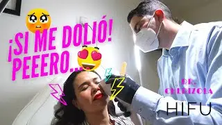 Hifu facial, antes y después. ¿Rejuvenecimiento facial sin cirugía?