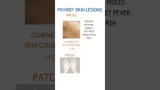 SKIN LESIONS Macule vs Patch