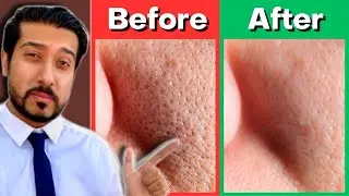 How to Minimize Pores Fast and Easy | Shrink BIG Pore Appearance