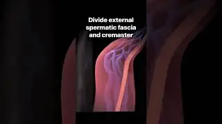Microscopic varicocelectomy